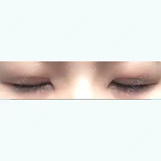 32日目の経過画像（1枚目）