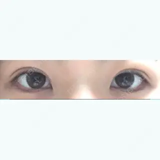 41日目の経過画像（1枚目）