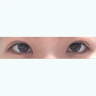 45日目の経過画像（1枚目）