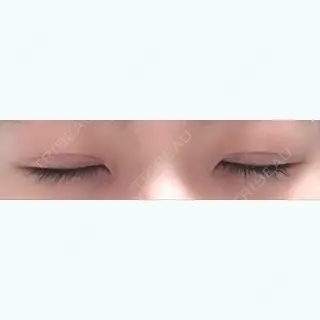 50日目の経過画像（2枚目）
