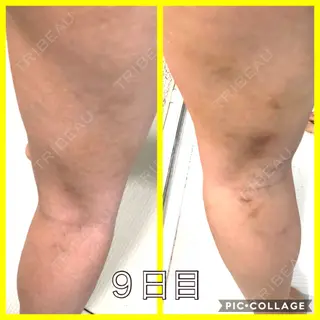 9日目の経過画像（3枚目）
