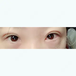 1日目の経過画像（2枚目）