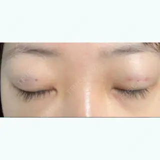 2日目の経過画像（1枚目）