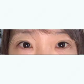 2日目の経過画像（2枚目）