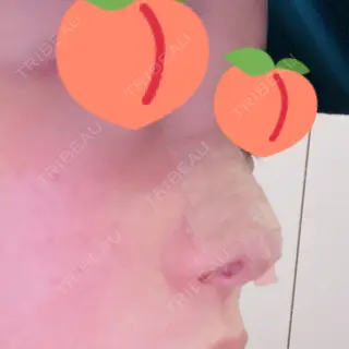 0日目の経過画像（2枚目）
