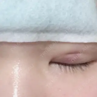 1日目の経過画像（1枚目）