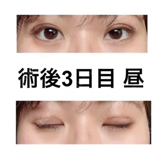 3日目の経過画像（1枚目）