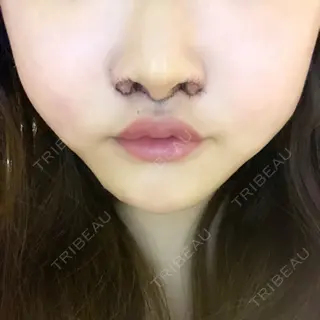 4日目の経過画像（2枚目）