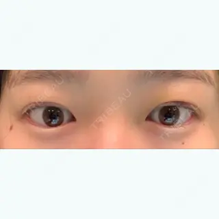 3日目の経過画像（2枚目）