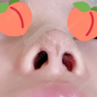 1日目の経過画像（3枚目）