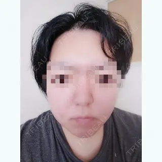3日目の経過画像（1枚目）