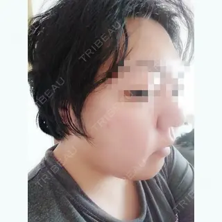 3日目の経過画像（2枚目）