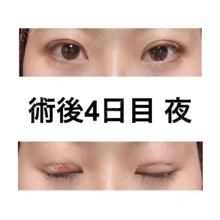 4日目の経過画像（2枚目）