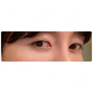 39日目の経過画像（3枚目）