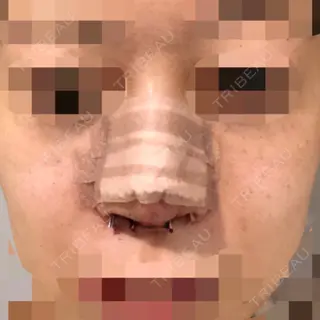 0日目の経過画像（1枚目）