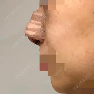 0日目の経過画像（2枚目）