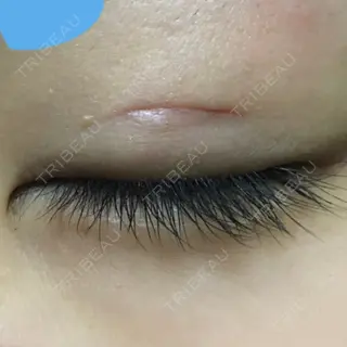 7日目の経過画像（3枚目）