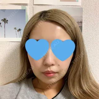 8日目の経過画像（1枚目）