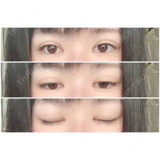 11日目の経過画像（2枚目）
