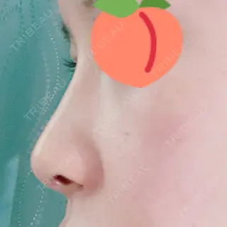 2日目の経過画像（1枚目）