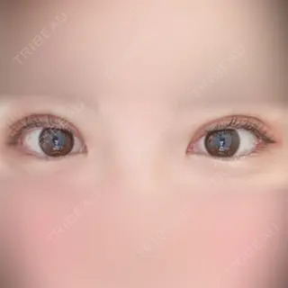 0日目の経過画像（2枚目）