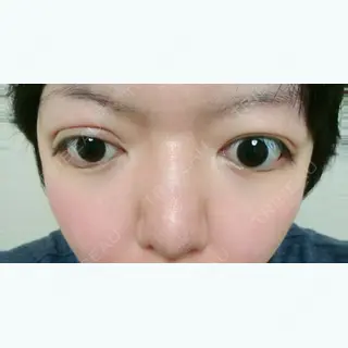 0日目の経過画像（1枚目）