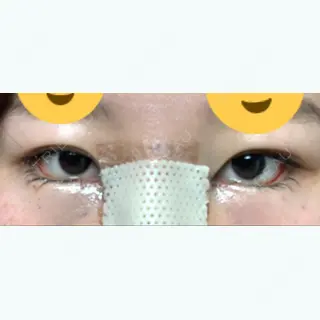 1日目の経過画像（1枚目）