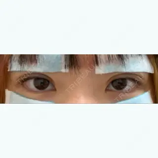 0日目の経過画像（1枚目）