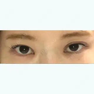 0日目の経過画像（1枚目）