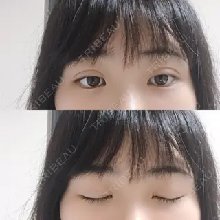 3日目の経過画像（2枚目）
