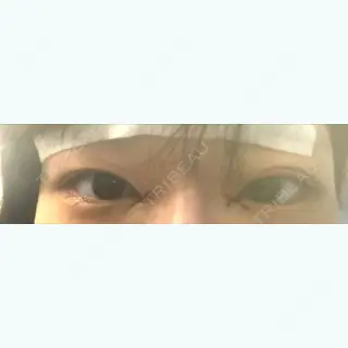 0日目の経過画像（1枚目）