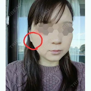 25日目の経過画像（3枚目）