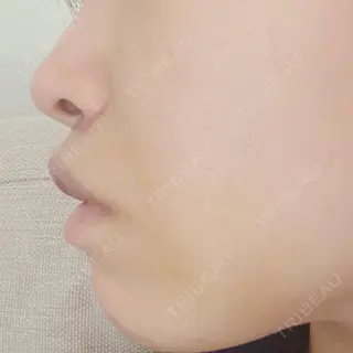 8日目の経過画像（2枚目）