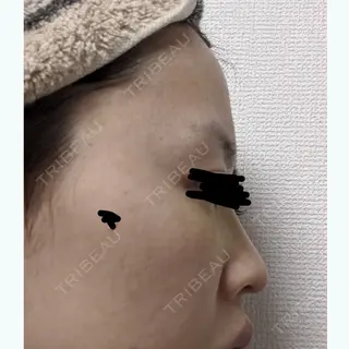 6日目の経過画像（3枚目）