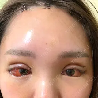 6日目の経過画像（1枚目）