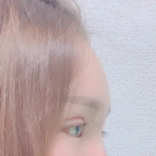 12日目の経過画像（2枚目）