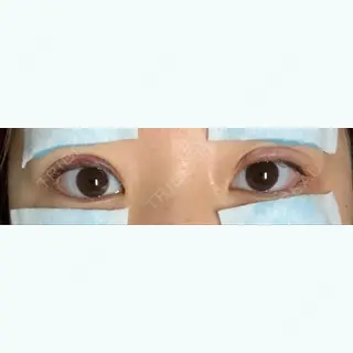 1日目の経過画像（1枚目）