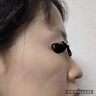 7日目の経過画像（3枚目）