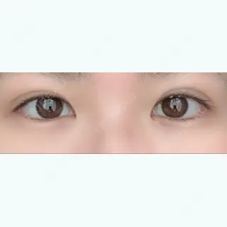 26日目の経過画像（1枚目）