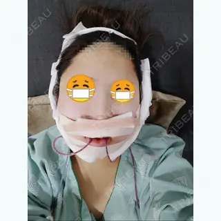 0日目の経過画像（1枚目）
