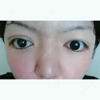 2日目の経過画像（1枚目）