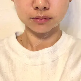 4日目の経過画像（1枚目）