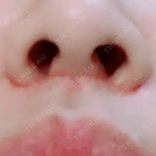 38日目の経過画像（3枚目）