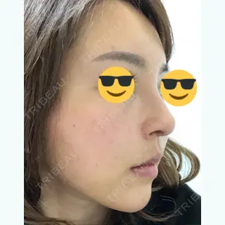 49日目の経過画像（1枚目）