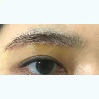 6日目の経過画像（1枚目）
