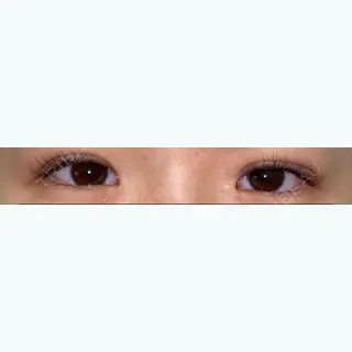 0日目の経過画像（1枚目）