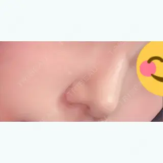 33日目の経過画像（2枚目）