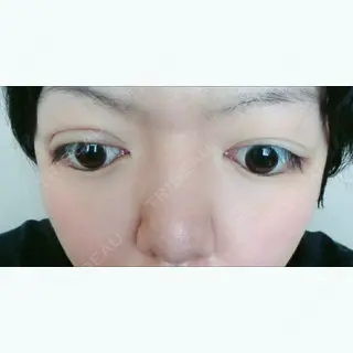 3日目の経過画像（2枚目）