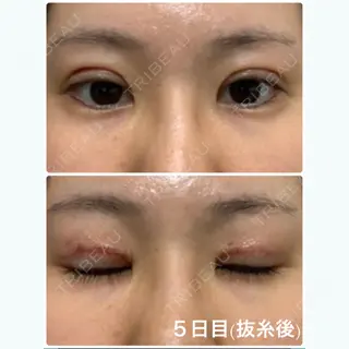 5日目の経過画像（1枚目）