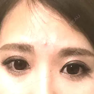 32日目の経過画像（1枚目）